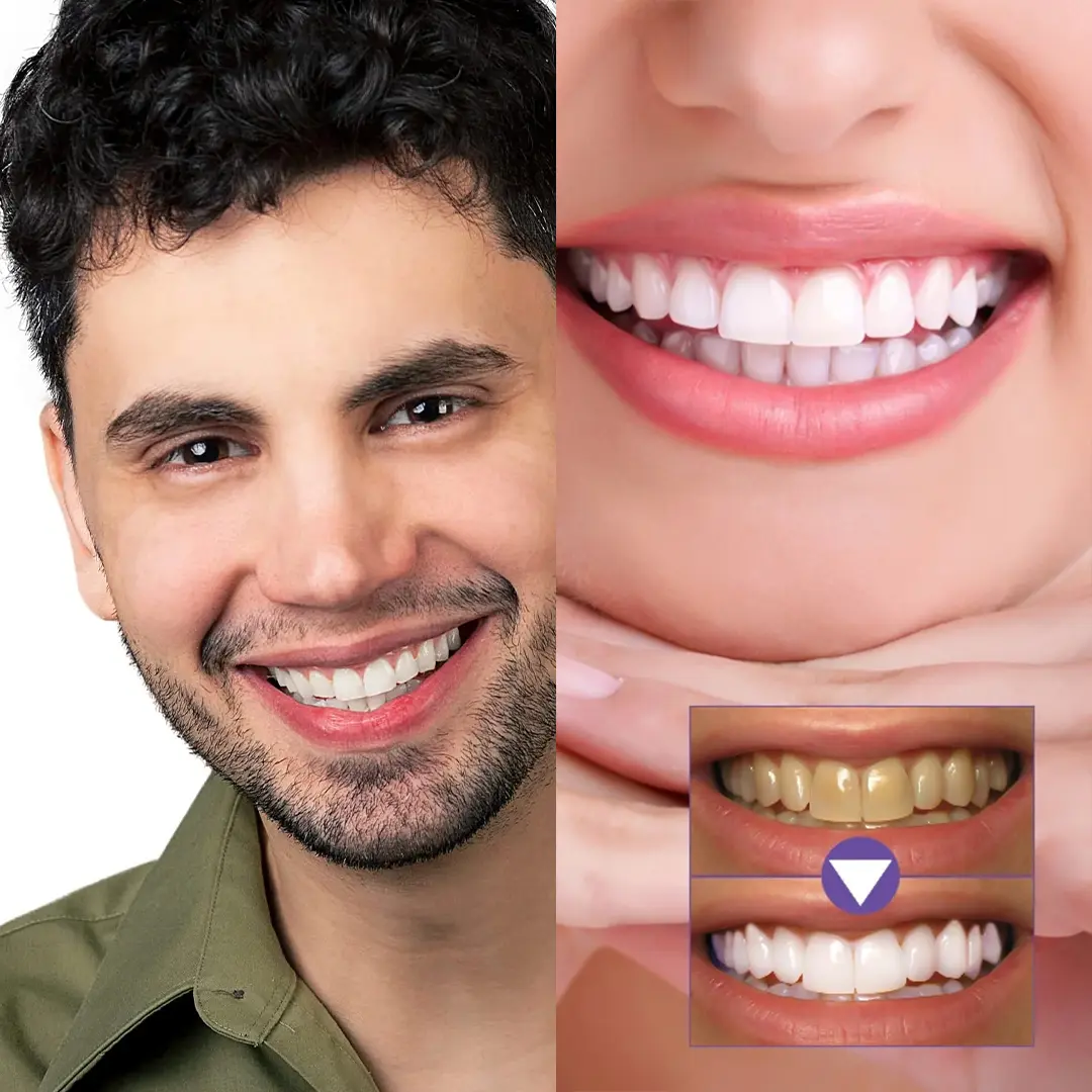 جل تبييض الأسنان - الصورة 6